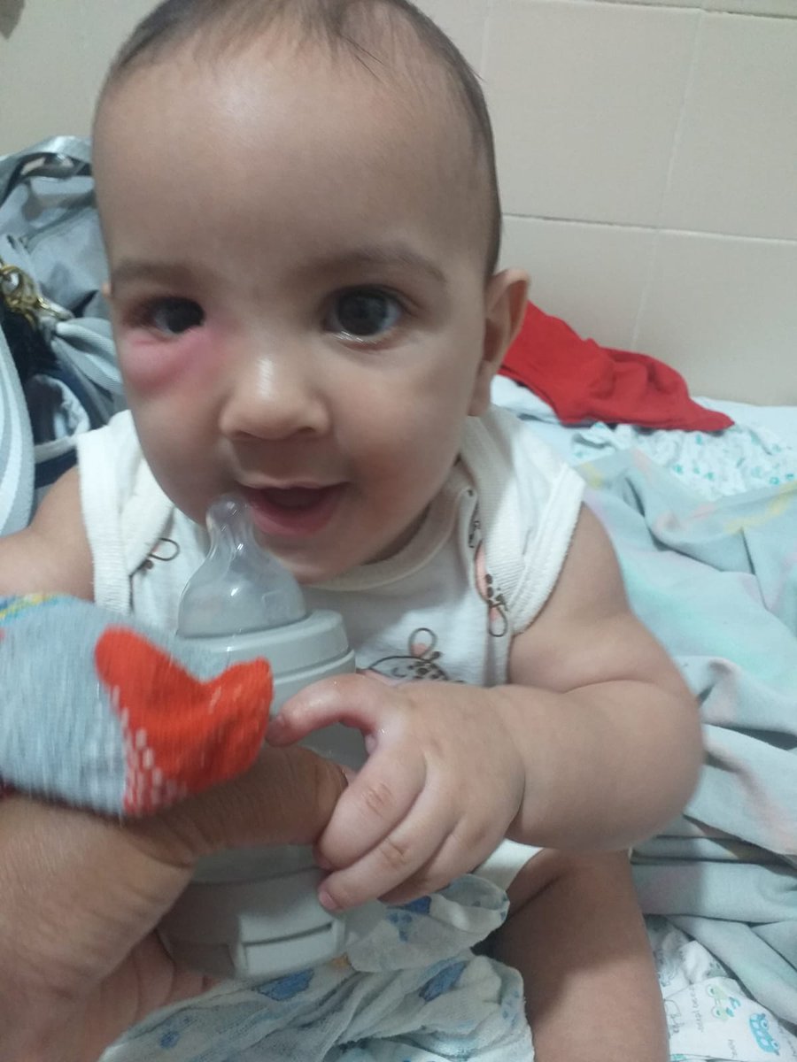 janainaamaeira's tweet photo. Hoje vi uma mamãe que conseguiu o valor da vaquinha e me motivei a fazer a do meu filho também ele se chama nadson levy tem apenas 7 meses está com dacriocistite uma inflamação no canal lacrimal e precisa de uma sondagem. Na minha cidade esse procedimento só faz particular ++ https://t.co/WWitqg5nQU