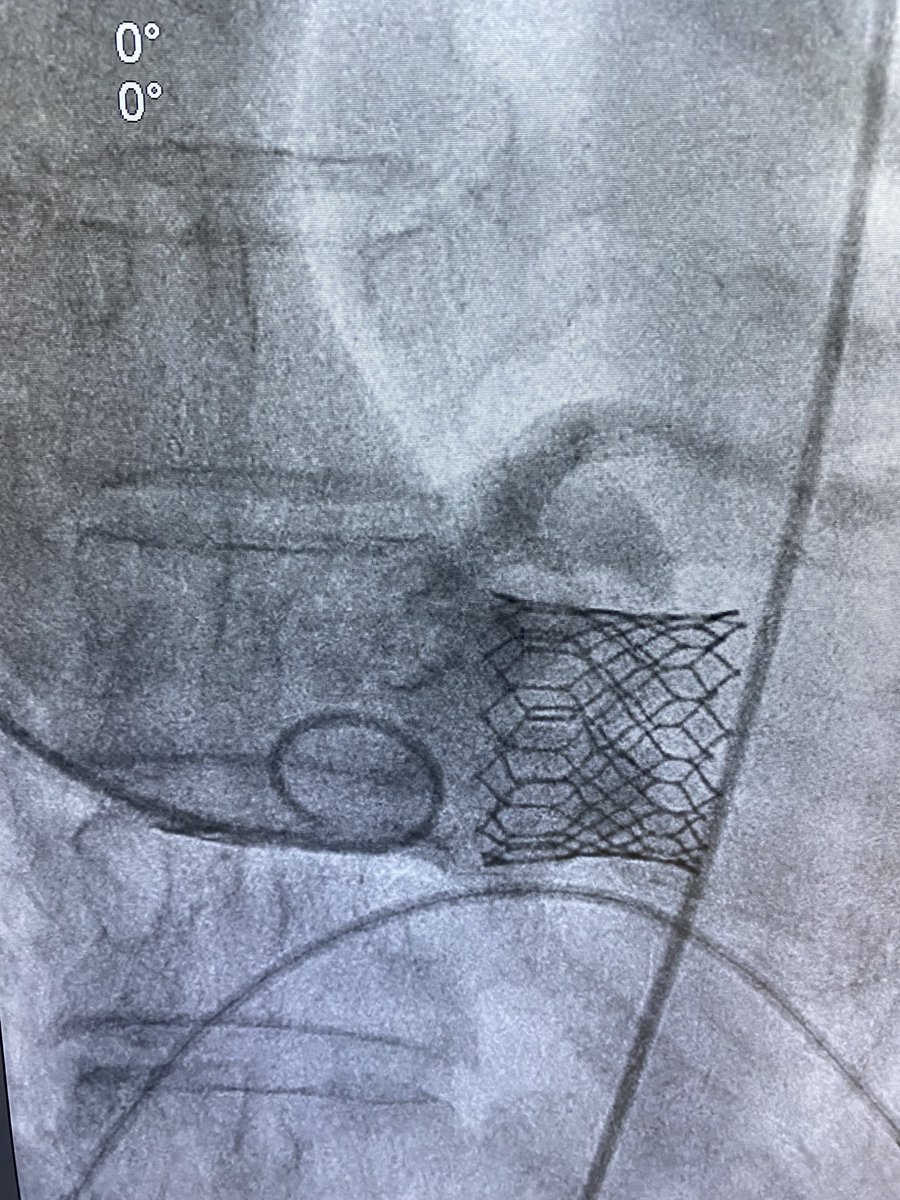 Jonyap88's tweet photo. Two really challenging #TAVI cases recently. One with a AV calcium score of >6000 and low coronary and one with a very horizontal aorta. #NHCS #NhcsStructur #StructuralIntervention @Hokaywoon1 @keesoon99 https://t.co/pccG0PyJNS
