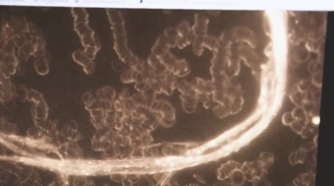 RealDrJaneRuby's tweet photo. In early 2021, I brought you the evidence of damaged blood from the C 19 shots, we didn't know at the time what the material was, perhaps we were seeing hydrogel at that time

But you can see the damage to the red blood cells, dysmorphic shapes, profound rouleaux, and the shocking metallic, luminescent pieces later identified as GRAPHENE ribbons

Dr Philippe VanWelbergen was an early whistleblower hero