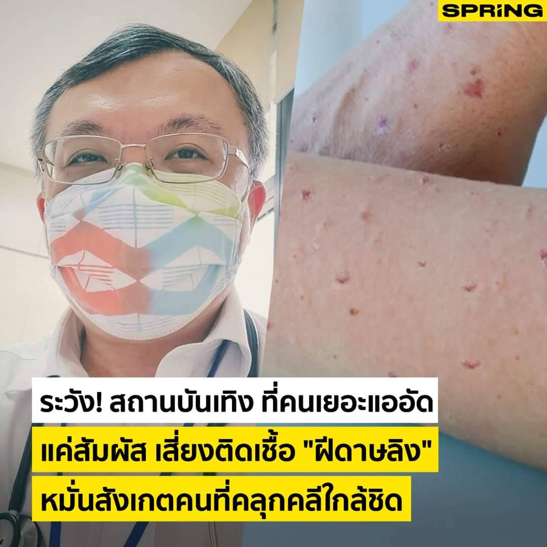 lekanoi's tweet photo. Mpox เคสเริ่มมาตรวจกันเรื่อยๆ และก็เจอติดเชื้อกันเพิ่มขึ้นเรื่อยๆ

โดยเฉพาะคนไข้เอชไอวีที่มี CD4 ต่ำๆ ติดเชื้อเชื้อลงปอดโอกาสเป็นปอดอักเสบ เชื้อขึ้นสมองเยื่อหุ้มสมองอัก��สบได้นะครับ https://t.co/fTmapkW6HN