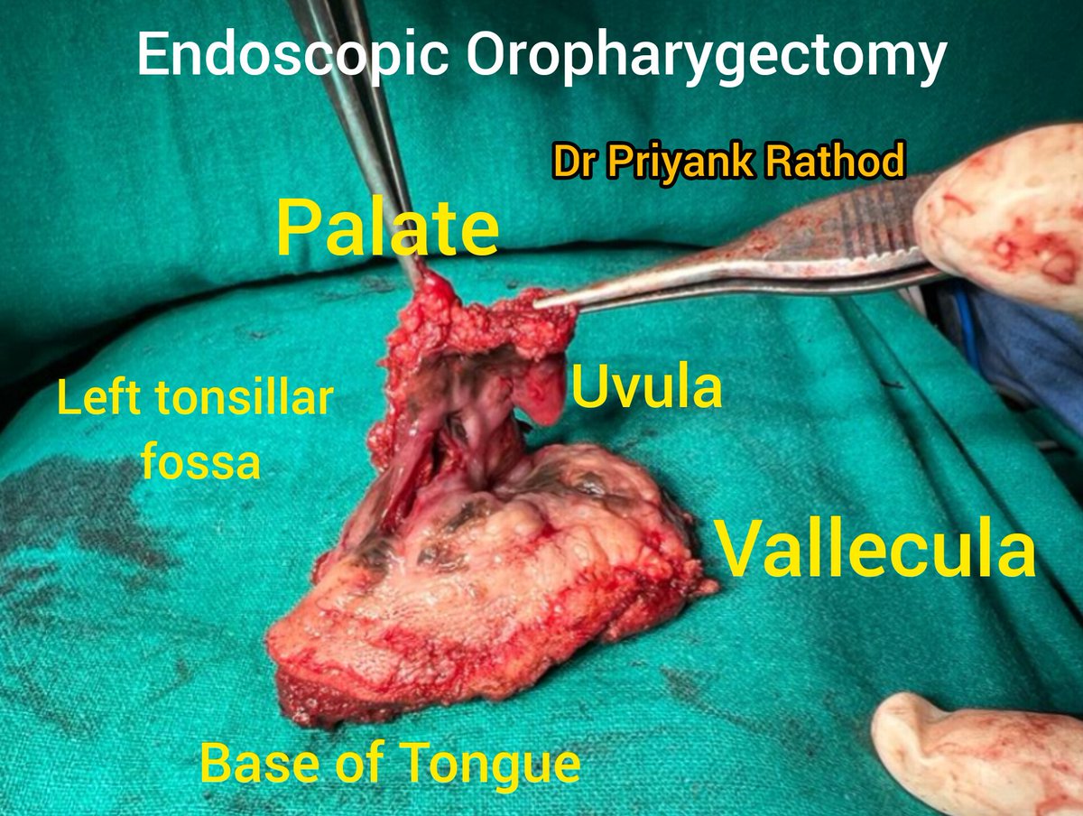 Dr. Priyank Rathod (@drpriyankratho1) on Twitter photo Endoscopic Mucosal melanoma oropharyngectomy #headandneckcancer #oncology #cancer #oncosurgery #cancertreatment #CancerResearch #hnonco #oralhealth #oralonco
#Ahmedabad #Vadodara #gujarat
#mouthcancer
<a href="/timesofindia/">The Times Of India</a>
<a href="/bonestumor/">Dr Abhijeet Ashok Salunke</a> <a href="/CancerCentral2/">Dr Shivam (MS, M.Ch Surg Onco)</a> <a href="/GCRI_1972/">GCRI</a> <a href="/civilhospamd/">civilhospitalamdavad</a> Endoscopic Mucosal melanoma oropharyngectomy #headandneckcancer #oncology #cancer #oncosurgery #cancertreatment #CancerResearch #hnonco #oralhealth #oralonco
#Ahmedabad #Vadodara #gujarat
#mouthcancer
<a href="/timesofindia/">The Times Of India</a>
<a href="/bonestumor/">Dr Abhijeet Ashok Salunke</a> <a href="/CancerCentral2/">Dr Shivam (MS, M.Ch Surg Onco)</a> <a href="/GCRI_1972/">GCRI</a> <a href="/civilhospamd/">civilhospitalamdavad</a>