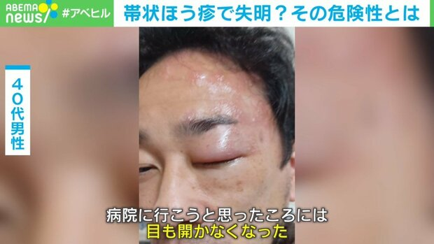 livedoornews's tweet photo. 【要注意】帯状疱疹で失明危機…40歳男性「目の奥の神経が壊されていたらしい」
https://t.co/2XhEloDfHs

皮膚に起こる病気だが、目元に発症した場合は失明の可能性があるという。男性は、目の奥がえぐられるような、あまり経験したことがないジンジンする痛みが、ほぼ1日中続いたそう。 https://t.co/D6rDjUZGRG
