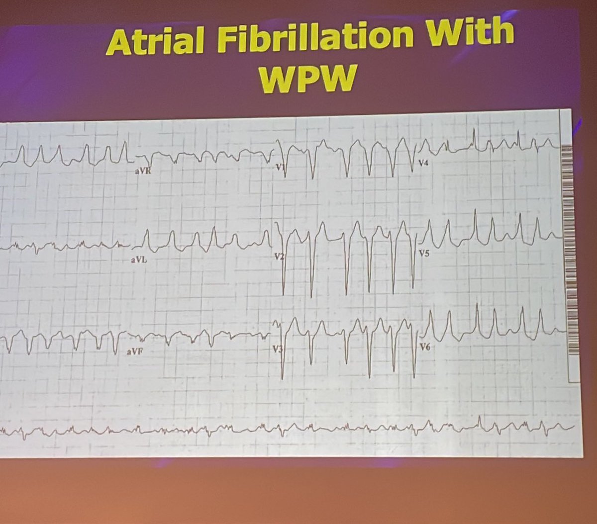 rob_cosentini's tweet photo. TachyArrhythmias via @amalmattu at #CorConference

WCT

➡️ think it’s VT

➡️ AF with WPW —> shock https://t.co/2bHJHQN6ax