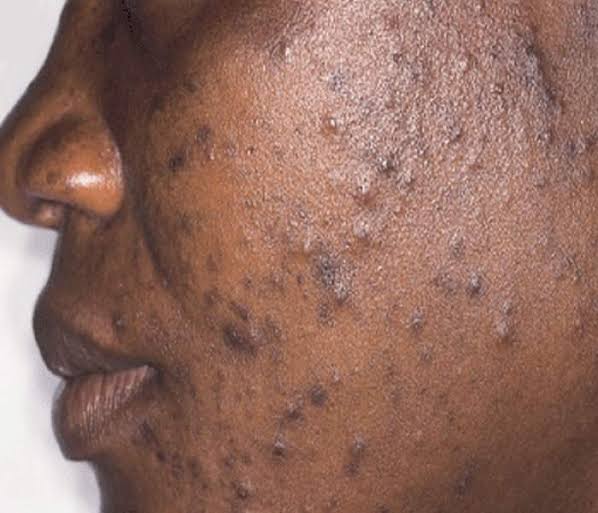 NaijaFarmerTips Pimples, Acne, Eczema etc can be embarrassing Esp on