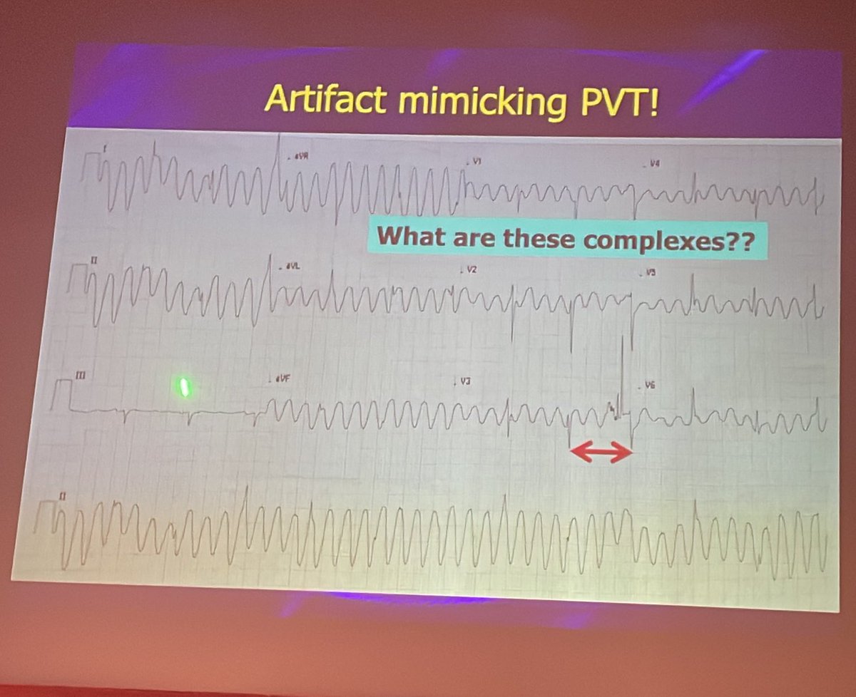 rob_cosentini's tweet photo. Arrhythmias via @amalmattu at #CorConference

Artifacts

➡️ look for all leads

➡️ look for regular ventricular breasts https://t.co/0IQoJ8YAzd