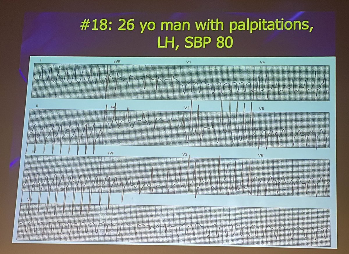 rob_cosentini's tweet photo. Arrhythmias via @amalmattu at #CorConference

Tachy with Pre-excitation 

➡️ Delta wave not always present/not all waves

➡️ look for short PR interval https://t.co/MkkK4DcsWA