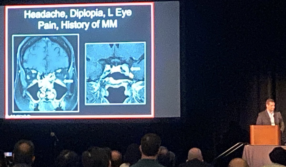 Tabby A. Kennedy, MD (@tabby_kennedy) on Twitter photo Great talk <a href="/GregAvey/">Greg Avey</a> from <a href="/UWiscNeuroRad/">University of Wisconsin Neuroradiology</a> highlighting advanced imaging techniques we use <a href="/UWiscRadiology/">UW Radiology</a> to improve image quality when evaluating the neck and skull base.
#ASHNR23 Great talk <a href="/GregAvey/">Greg Avey</a> from <a href="/UWiscNeuroRad/">University of Wisconsin Neuroradiology</a> highlighting advanced imaging techniques we use <a href="/UWiscRadiology/">UW Radiology</a> to improve image quality when evaluating the neck and skull base.
#ASHNR23