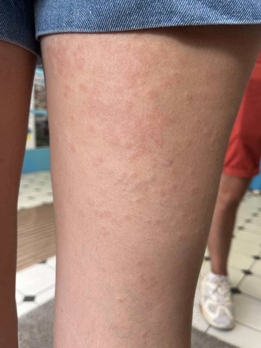 _DrBrownstone's tweet photo. #dermatotoctoc
Patiente de 24 ans aucun atcd éruption papuleuse non pruirigineuse depuis 4 mois sur tronc abdo au début puis depuis 3 semaines extension arrière cuisses puis jambes
Sérologies virales ist neg bio sans hypereosino pas de crp
Ketoconazole x3 tenté pas amelioration https://t.co/BnjQUd7RgX