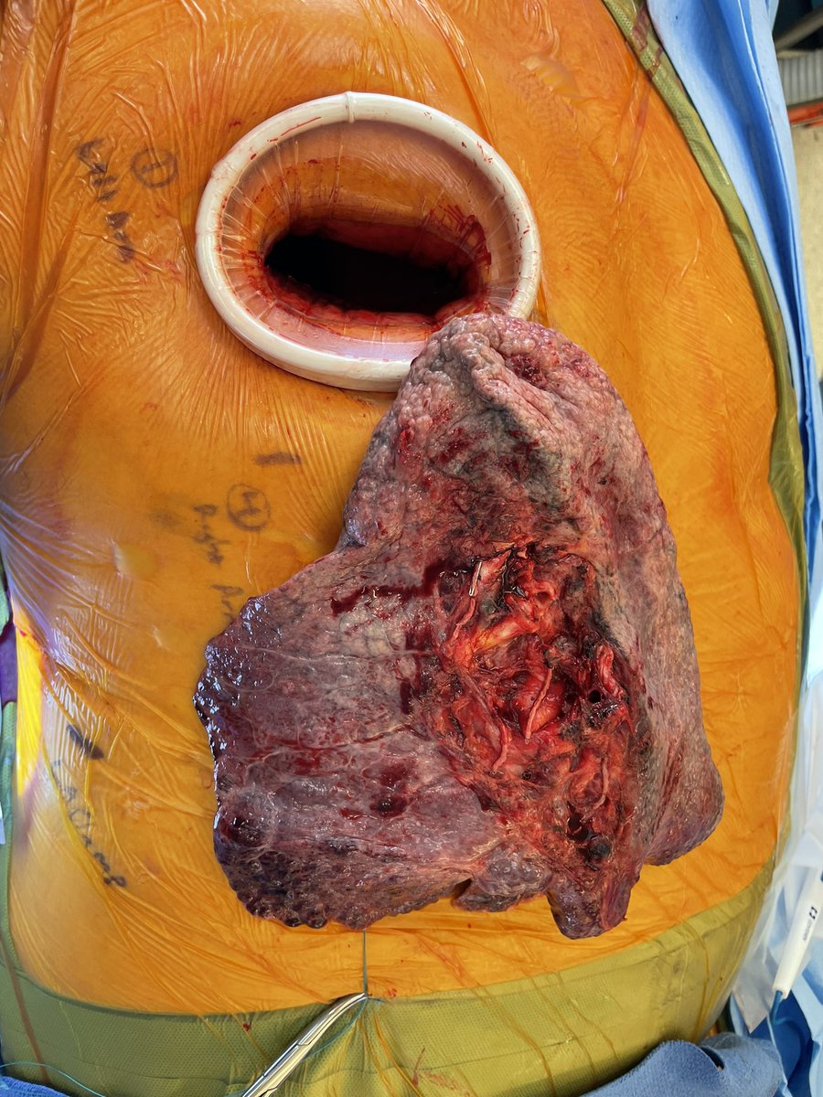 It’s not just getting the lung in through a small incision that is challenging- the old lung also has to come out through a 6cm hole! The lung here has pulmonary fibrosis, and patient transplanted using minimally invasive #lungtranaplant with the #robot.  <a href="/pacman8it/">Pedro Catarino</a> <a href="/ISHLT/">The ISHLT</a>