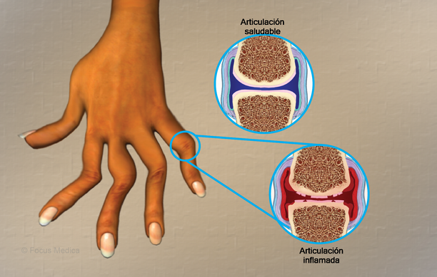 onaycu73's tweet photo. Artritis Reumatoide
Es una enfermedad autoinmune ya que el sistema inmunológico ataca las propias células y tejidos del cuerpo. PARA
📷ALIVIAR,📷MEJORAR📷PREVENEIR
LA ARTRITITIS ES OLIFE, NUESTRA INFUSIÓN DE HOJAS DE OLIVOS LISTA PARA CONSUMIR.
https://t.co/uJEQv6Pffi https://t.co/xX7oiKNWxm