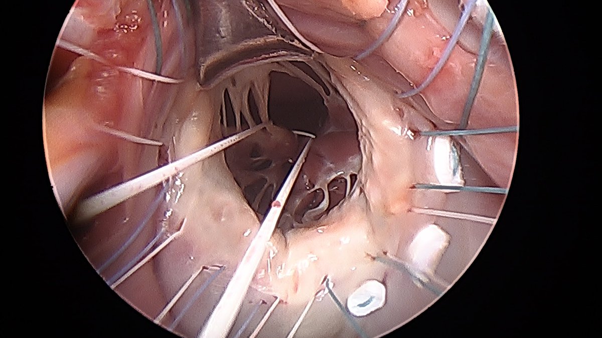 Cardiac Surgery Gregorio Marañon Hospital tweet media