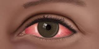 Let's discuss ‘Apollo’
-A common eye infection during this rainy period. 
“Apollo" is an inflammation of the thin transparent layer (conjunctiva covering the white part (sclera) of the eye.

It is medically called ACUTE HEMORRHAGIC CONJUNCTIVITIS. #askdrada