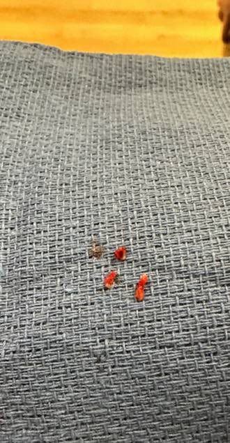 Don Garbett (@dongarbettmd) on Twitter photo 60 ish yr old with cardioembolic popliteal artery thrombosis. No improvement after 48hrs lysis. Efficient thrombectomy with <a href="/PenVascular/">Penumbra Vascular</a> Bolt 7. <a href="/t_intheleadcoat/">Venkat Tummala MD</a> <a href="/SriniTummala/">Srini Tummala MD FSIR FSVM</a> <a href="/AmputationSuck/">👊🏾👍🏾BT Fisher Sr., MD</a> 60 ish yr old with cardioembolic popliteal artery thrombosis. No improvement after 48hrs lysis. Efficient thrombectomy with <a href="/PenVascular/">Penumbra Vascular</a> Bolt 7. <a href="/t_intheleadcoat/">Venkat Tummala MD</a> <a href="/SriniTummala/">Srini Tummala MD FSIR FSVM</a> <a href="/AmputationSuck/">👊🏾👍🏾BT Fisher Sr., MD</a>