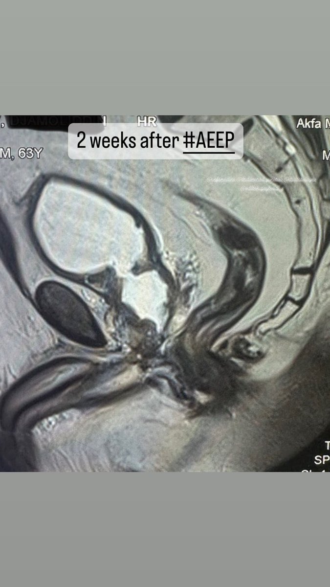 Two weeks after anatomical endoenucleation #AEEP @trwherrmann @scoffonecesare @Mohamedendourol @DocGauhar @DongNguyeb @D_Castellani @dilmuratuz