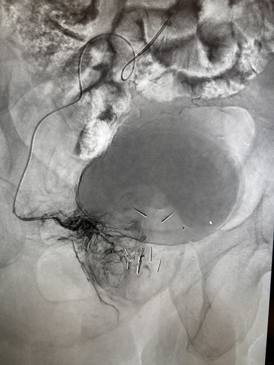 Don Garbett (@dongarbettmd) on Twitter photo #PAE femoral vs radial <a href="/StreamMeeting/">STREAMmeeting</a> choose wisely. 60ish yo with 160gr prostate s/p #urolift (great solution, but too big for this) #PAE femoral vs radial <a href="/StreamMeeting/">STREAMmeeting</a> choose wisely. 60ish yo with 160gr prostate s/p #urolift (great solution, but too big for this)