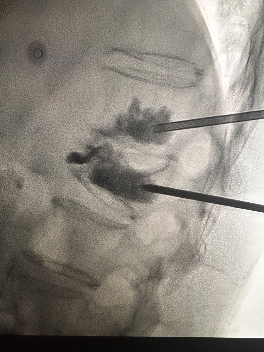Don Garbett (@dongarbettmd) on Twitter photo 60 ish yr old with persistent pain after L1 kyphoplasty. Repeat MR showed L1 edema and anterior T12 corner fracture. Repeat kypho at L1 targeting the superior end plate and T12 anterior corner treatment. Pain down from 10/10 to 2/10. thank you <a href="/dougbeall/">Douglas Beall</a> <a href="/ImagingDoctor/">Dana Dunleavy, MD</a> 60 ish yr old with persistent pain after L1 kyphoplasty. Repeat MR showed L1 edema and anterior T12 corner fracture. Repeat kypho at L1 targeting the superior end plate and T12 anterior corner treatment. Pain down from 10/10 to 2/10. thank you <a href="/dougbeall/">Douglas Beall</a> <a href="/ImagingDoctor/">Dana Dunleavy, MD</a>