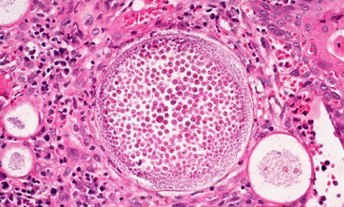 <a href="/JMGardnerMD/">Jerad Gardner, MD</a> <a href="/sadiqamer/">Sadiq M Amer, MD</a> Rinosporidiosis