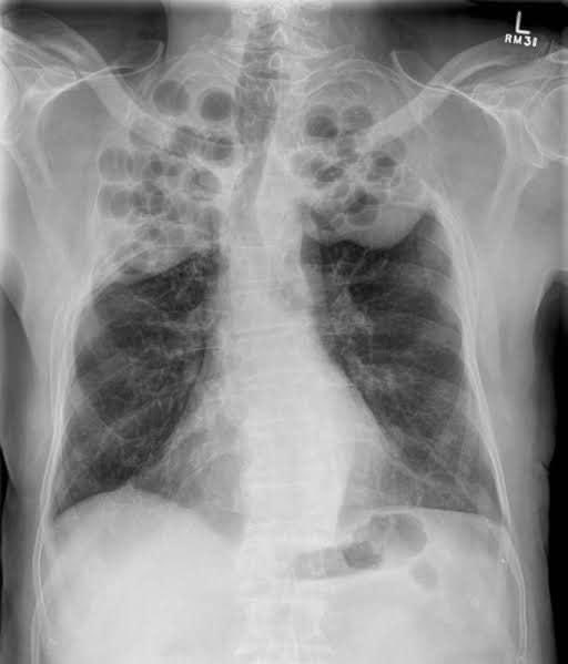 arbat_dr's tweet photo. Pulmonology Trivia - Blast from the Past !!! An Anomaly or an Optical Illusion??? Can someone tell me what’s going on here?

#interventionalpulmonology #ebus #cryobiopsy #bronchoscopy #lungspecialist  #lungcancer #drsameerarbat #onehealthcare #pulmonologist #nagpur #india🇮🇳 https://t.co/Pf69Sc357l