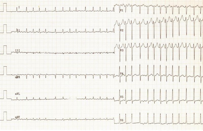 ItsInfusion's tweet photo. A 35 year old man presents with palpitations. He has been drinking heavily with friends over the weekend. This is his ECG. Present your findings and give a diagnosis. https://t.co/6OKabFRqJj