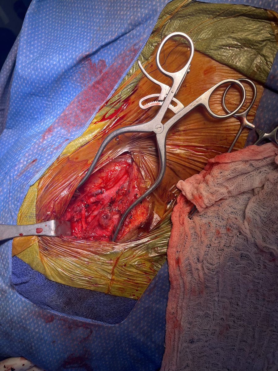 Carotid artery exposure with mandibular subluxation for a 2.2 ICA 
pseudoaneurysm. Requires teamwork and careful preop planning 
<a href="/VascularSVS/">Society for Vascular Surgery</a> <a href="/JamaicaHospital/">Jamaica Hospital</a> <a href="/FHMC_NYC/">FlushingHospital</a>