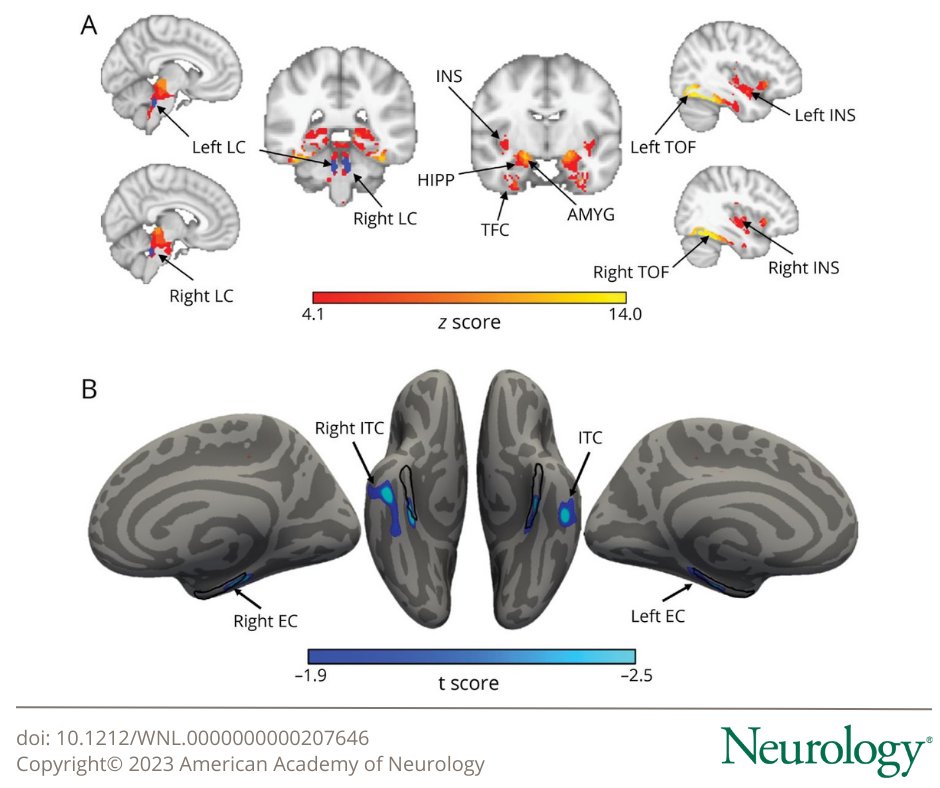 Association of Novelty-Related Locus Coeruleus Function With Entorhinal Tau Deposition and Memory Decline in Preclinical #Alzheimer Disease: bit.ly/3t2XXm5 #NeuroTwitter