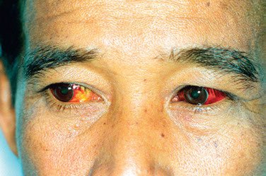 Patient returns from holiday in Thailand with fever, jaundice and renal failure. What’s the diagnosis?