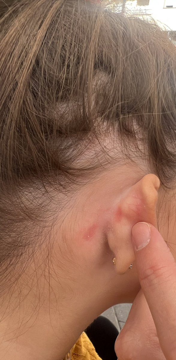estherlluis's tweet photo. @RockAHulaHI Compré el viernes una diadema de Rockahula y a mi hija le está saliendo una reacción alérgica… Si es un artículo para niños, creo que se debería vigilar qué productos se usan… https://t.co/OBfUAAiszU