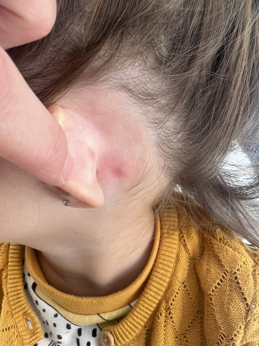 estherlluis's tweet photo. @RockAHulaHI Compré el viernes una diadema de Rockahula y a mi hija le está saliendo una reacción alérgica… Si es un artículo para niños, creo que se debería vigilar qué productos se usan… https://t.co/OBfUAAiszU
