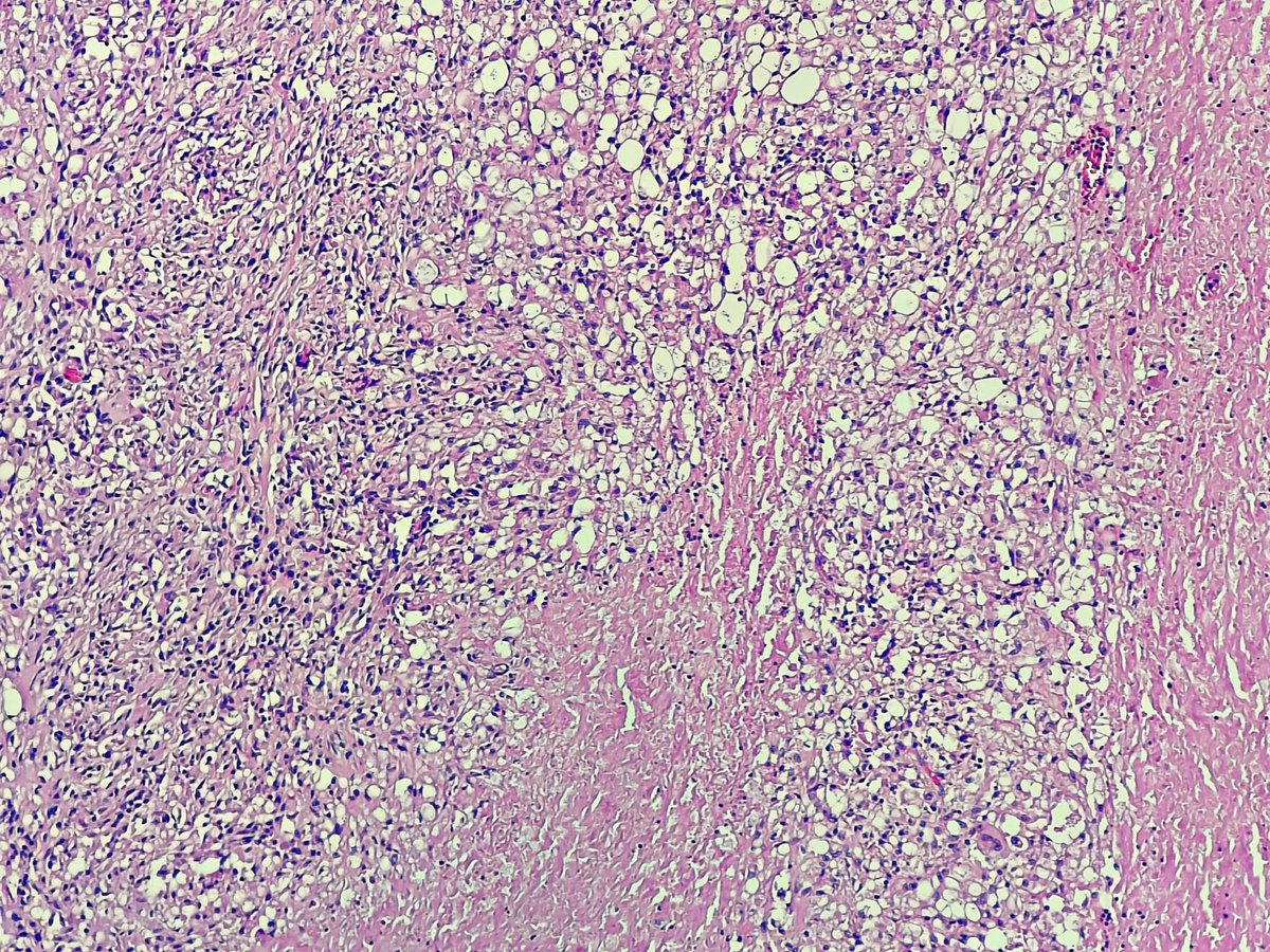 Swathiprabhu5's tweet photo. Female in her late forties with multiple lymphadenopathy #KAPCON2023 #KAPCONPathX2023 https://t.co/PKVuReB8fi
