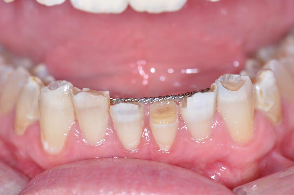 Recorded Webinar-Using 10% Carbamide Peroxide For Caries Prevention by Lee Ann Brady DMD <a href="/LeeAnnBrady/">Lee Ann Brady</a> #dentistry bit.ly/3CxGG6d