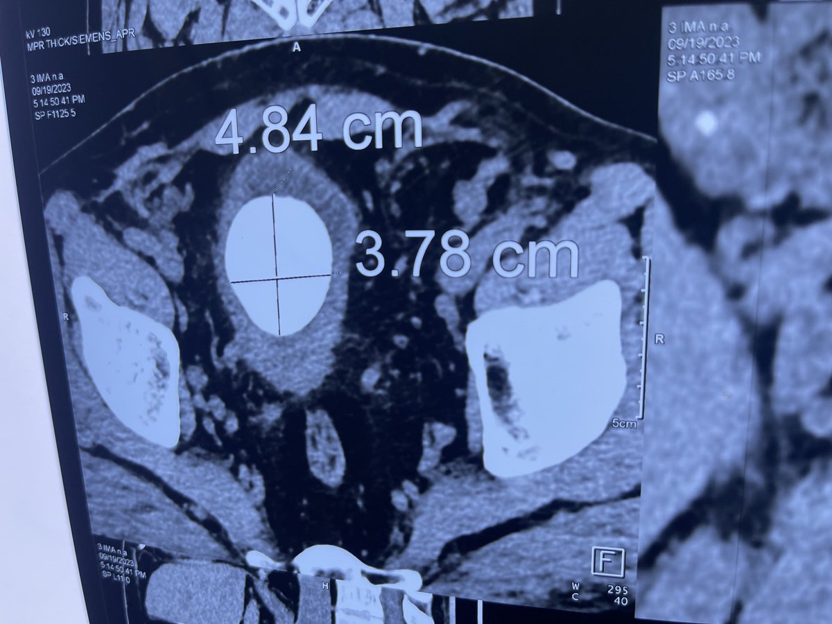 Mahmoud Elnagar (@masalek65) on Twitter photo Large prostate 100 gm and large vesical stone. What are the options?<a href="/mohamed92902484/">mohamed elshazly</a> <a href="/Mohamedendourol/">Mohamed_omar</a> <a href="/TFL_URO_APIS/">APIS KidneyStone Institute, TFL EndoUrology Center</a> <a href="/fgomsan/">Fernando GomezSancha</a> <a href="/drkemalsarica/">Kemal Sarıca</a> <a href="/sbinhamrii/">Saeed Bin Hamri</a> <a href="/StefaniaFerret/">Stefania Ferretti</a> Large prostate 100 gm and large vesical stone. What are the options?<a href="/mohamed92902484/">mohamed elshazly</a> <a href="/Mohamedendourol/">Mohamed_omar</a> <a href="/TFL_URO_APIS/">APIS KidneyStone Institute, TFL EndoUrology Center</a> <a href="/fgomsan/">Fernando GomezSancha</a> <a href="/drkemalsarica/">Kemal Sarıca</a> <a href="/sbinhamrii/">Saeed Bin Hamri</a> <a href="/StefaniaFerret/">Stefania Ferretti</a>