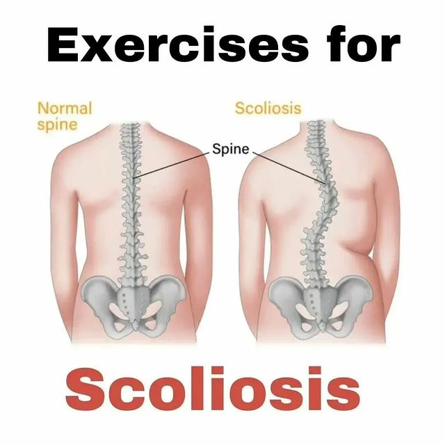 CadioArena's tweet image. Exercises for Scoliosis...