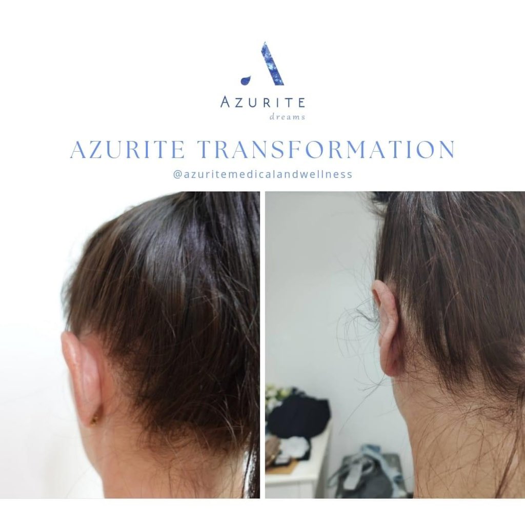 Day 11 post op with ear pinning, make you more confident

Visit our website: azurite.com.au

#surgerythailand #earpinning #ConfidentLook #surgeryrecovery #surgerysuccess
