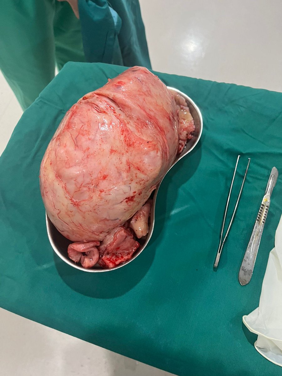 weirdniss's tweet photo. [TW: BLOOD] 
Hari ini sebulan pasca operasi pengangkatan miom. Masih agak asing dengan kondisi perut yang nggak lagi buncit hihi (iyalah, 2kg di perutku huhu kayak bayik)

aku mau share tentang miom ini dan kenapa bisa kena. https://t.co/qmySm6aJpZ