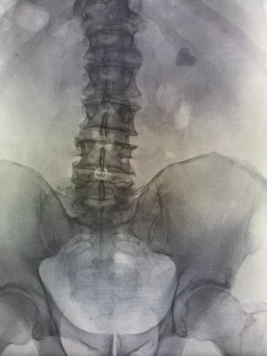 Who can resist for such an invitation??🩷<a href="/ZoltanKissDr/">Zoltán Kiss</a> @GoumasUrologia #pcnl #supine #endourology