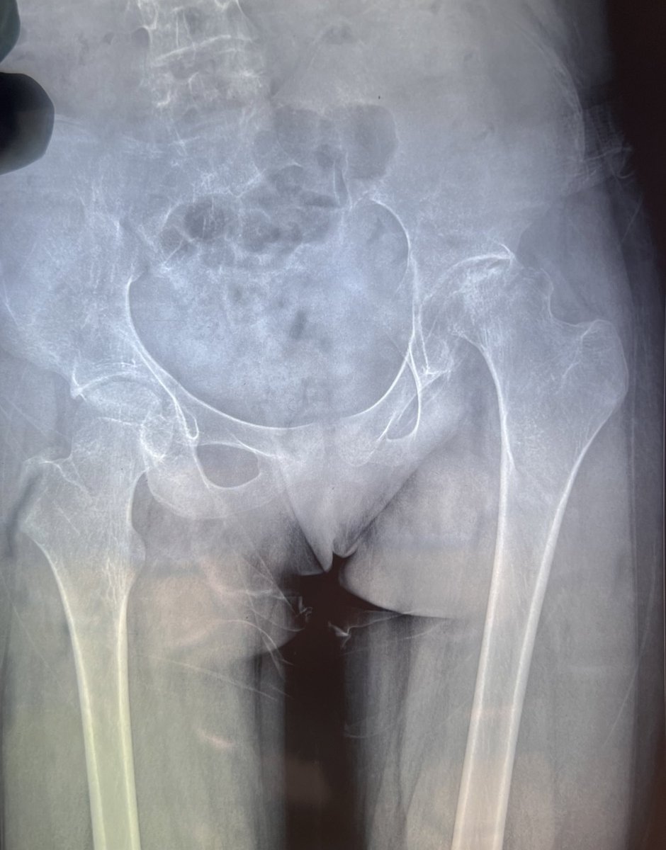 Question of the day! 

🧕 17/F

Referred ivo 😮‍💨🥵
Left groin pain and knee pain, no exposure to drugs…
 
Elicitable pain on examination! 

Cbc-9/4500/1.59L 

Diagnosis ❓

#MedTwitter 
#MedX #orthotwitter #ortho #radiotwitter #radiology #meded