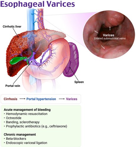med_interesting's tweet photo. 📍case of alcoholic patient who have esophageal varices, with hx of hematemesis, which of the following drugs
prevent re-bleeding in this patient?

propranolol✅ https://t.co/C4hD2yguti