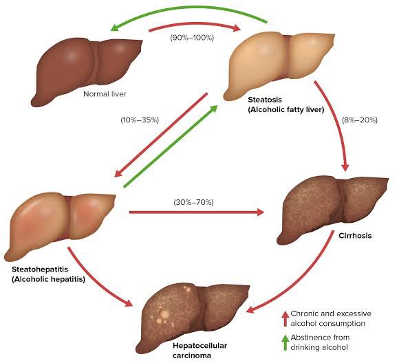 SENETORIAL22's tweet photo. Hey everyone! 👋 Just wanted to take a moment to talk about something important - liver damage. It's a serious health issue that we should all be aware of. Your liver is a superhero organ that helps detoxify your body, but certain things can cause damage to it. https://t.co/qrs0QrKArg