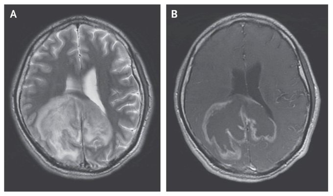 guerreroespejo's tweet photo. 31-y-o👨HIV +, CD4+ 60/mm3, from El Salvador: headache, confusion, fever, &amp; gait instability

MR: mass (A &amp; B, T2 and T1, contrast material)

Brain aspirate: (C)
1/4

DOI: 10.1056/NEJMicm1703763

#Neuro #parasitology #pathology https://t.co/gMl7lJIP6E