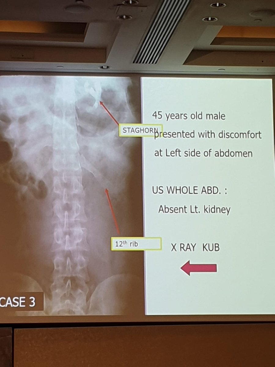 It was great to gain insights, catch up with old friends & make new ones @ #IAU23 in London. Personal highlight: discussing the challenges of female urologists with #PeterAlken & interacting with other legends of the Urolithiasis world @therealcchaussy @StefaniaFerret @f_ripa