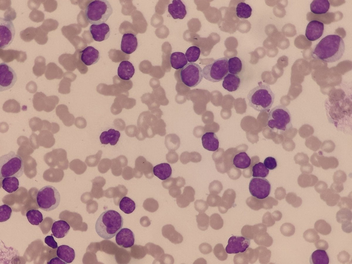 Case discussion: 
A 57 yr Male presented with Hb of 5.9 g/dl, Total count of 274800 and platelet count of 71000. Peripheral smear microphotograph attached. 
Likely Diagnosis ?
