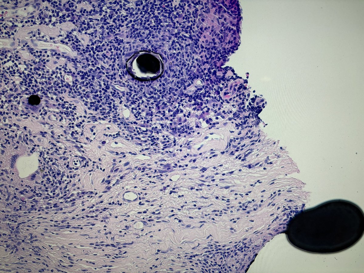 Anyone know what these are in this skin biopsy? #dermpath