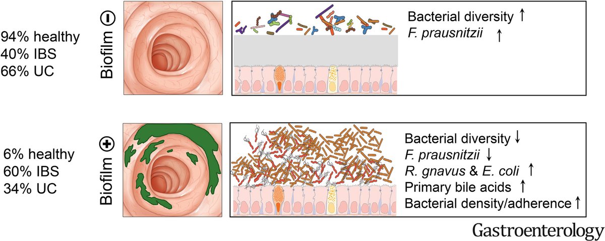 This week's most shared article:

Mucosal Biofilms Are an Endoscopic Feature of #IrritableBowelSyndrome and #UlcerativeColitis: ow.ly/AAhl50PU8o9

By authors from @meduni_wien