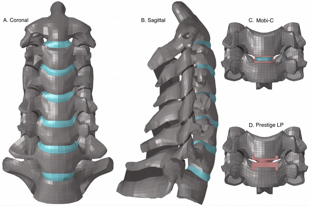 James Rutka (@jamesrutka) on Twitter photo Now, finite element analysis of the spine explained in this outstanding review by Marjorie Wang and colleagues in before print publication in <a href="/TheJNS/">Journal of Neurosurgery</a> #cervical #spinesurgery bit.ly/3RJKVUQ Now, finite element analysis of the spine explained in this outstanding review by Marjorie Wang and colleagues in before print publication in <a href="/TheJNS/">Journal of Neurosurgery</a> #cervical #spinesurgery bit.ly/3RJKVUQ