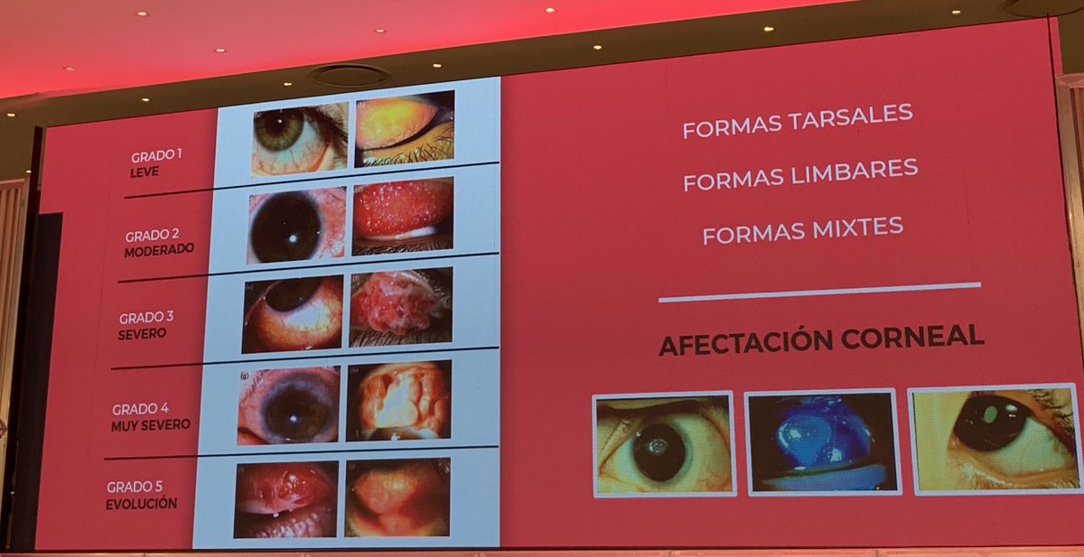 AndreaFer228's tweet photo. Clínica diferencial de patología ocular 👀 relevante en nuestra consulta #conjuntivitispapilargigante #conjuntivitisvernal #queratoconjuntivitisatopica #MPL23 https://t.co/oHeN8lHpqm
