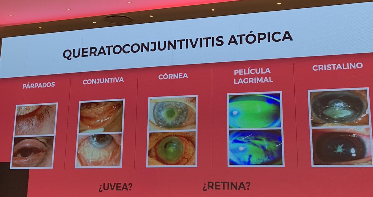 Clínica diferencial de patología ocular 👀 relevante en nuestra consulta #conjuntivitispapilargigante #conjuntivitisvernal #queratoconjuntivitisatopica #MPL23