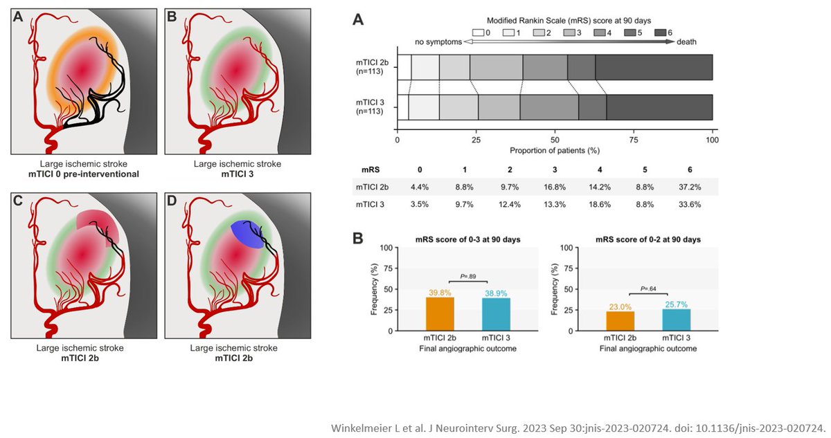 Jens Fiehler (@fie0815) on Twitter photo EVT in large core stroke: TICI2b sems to be enough ... jnis.bmj.com/content/early/… ⁉️<a href="/oozaidat/">Osama Zaidat MD</a> <a href="/TudorGJovin/">Tudor G. Jovin, MD</a> <a href="/JNIS_BMJ/">JNIS</a> <a href="/TENSIONstudy/">TENSION Study</a> @VladoKZg <a href="/MPeyT1/">Marios Psychogios</a> <a href="/WinkelmeierMD/">Laurens Winkelmeier</a> <a href="/BroocksGabriel/">Gabriel Broocks</a> EVT in large core stroke: TICI2b sems to be enough ... jnis.bmj.com/content/early/… ⁉️<a href="/oozaidat/">Osama Zaidat MD</a> <a href="/TudorGJovin/">Tudor G. Jovin, MD</a> <a href="/JNIS_BMJ/">JNIS</a> <a href="/TENSIONstudy/">TENSION Study</a> @VladoKZg <a href="/MPeyT1/">Marios Psychogios</a> <a href="/WinkelmeierMD/">Laurens Winkelmeier</a> <a href="/BroocksGabriel/">Gabriel Broocks</a>