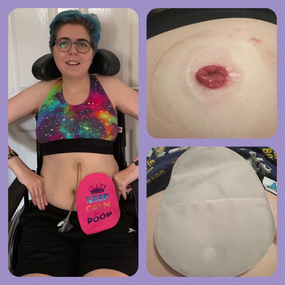 Today is #StomaAware Day are you STOMA aware ? I’ve had my STOMA since June 2021, let break down the barriers and be STOMA aware. Let’s break the social exclusion on STOMAS ! Let’s be STOMA positive and AWARE. #Stomaawarenessday #Ostomy #Stoma #Colostomy #Breakdownbarriers