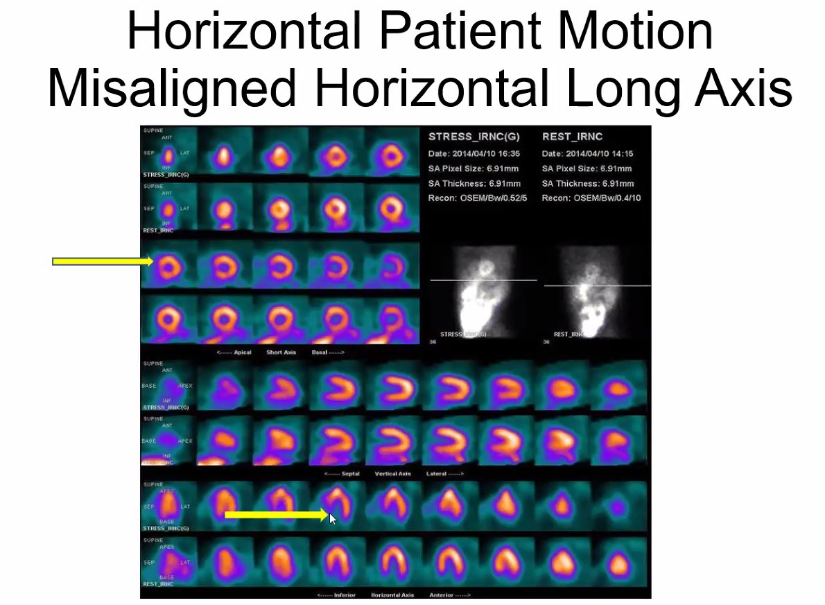 Great example of motion artifact on stress (top row). I always think of the distorted apex looking like the knuckle of a clenched fist! #ASNC2023