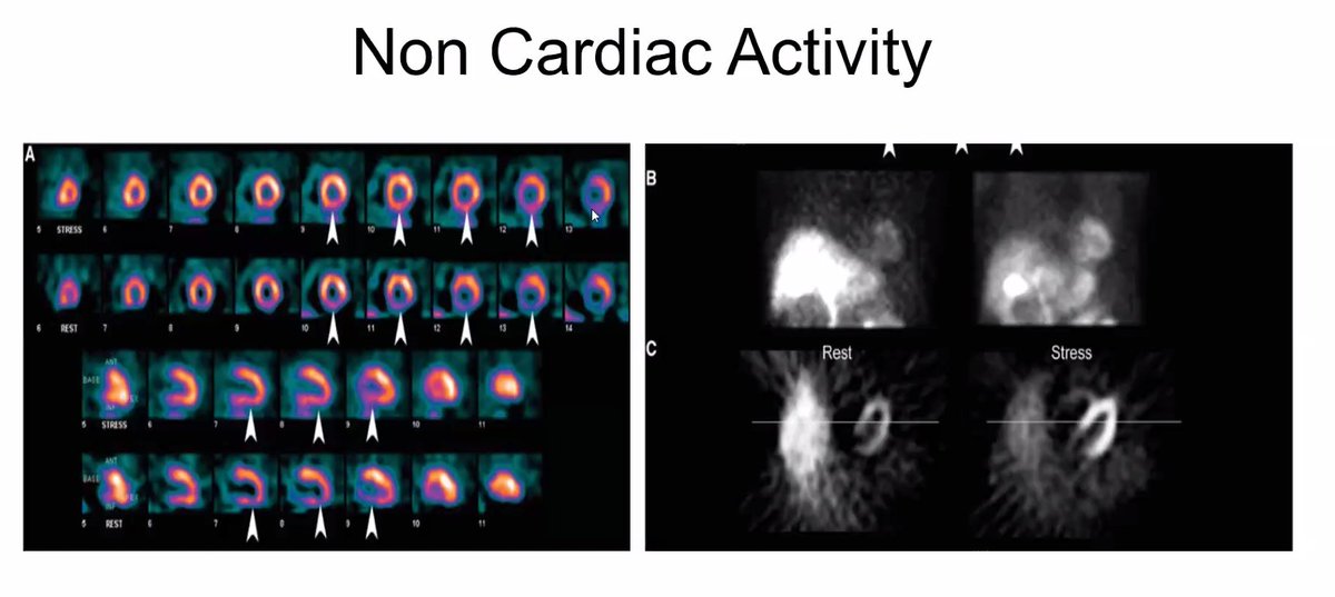 If you are still using FBP reconstruction... PLEASE move to iterative reconstruction. FBP is prone to negative pixel and streaking artifacts due to hot extra-cardiac activity. #ASNC2023